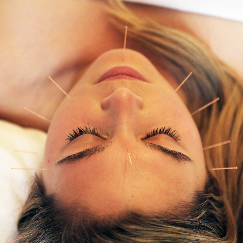 Glow Facial Acupuncture